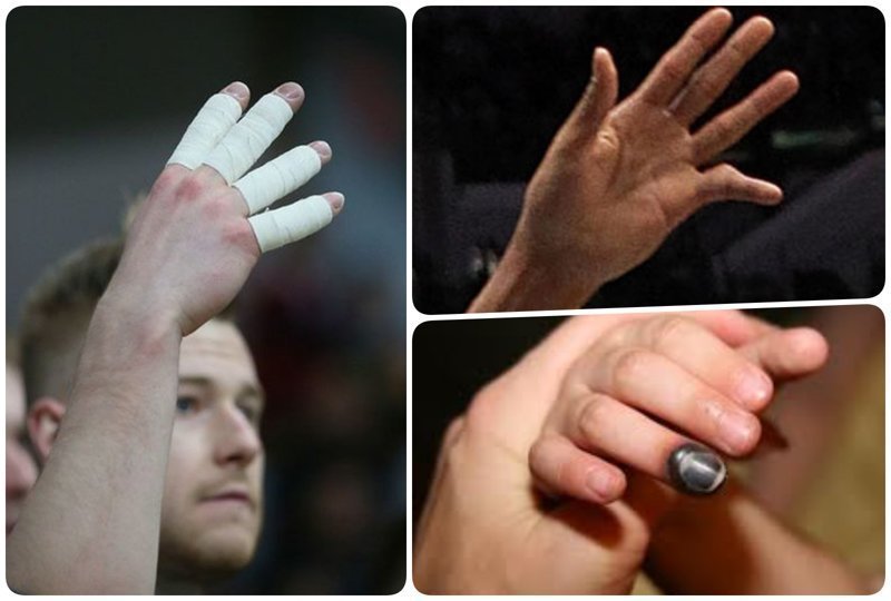3. Волейболисты не застрахованы от переломов запястья, выбитых и сломанных пальцев и других ушибов кисти