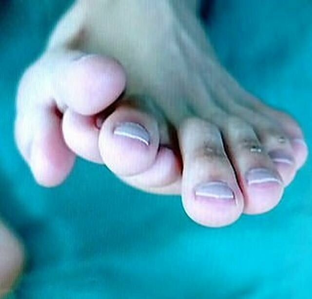 Оставили только пять: китайские хирурги удалили лишние пальцы с ноги пациента