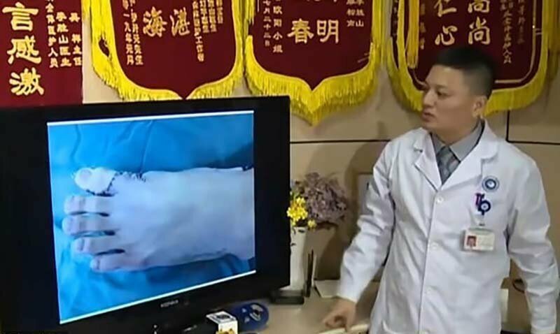Оставили только пять: китайские хирурги удалили лишние пальцы с ноги пациента