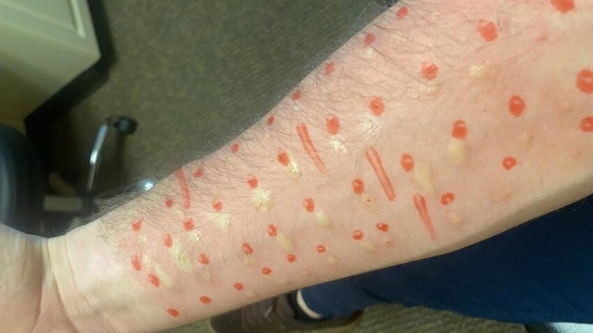 У моего друга аллергия буквально на всё