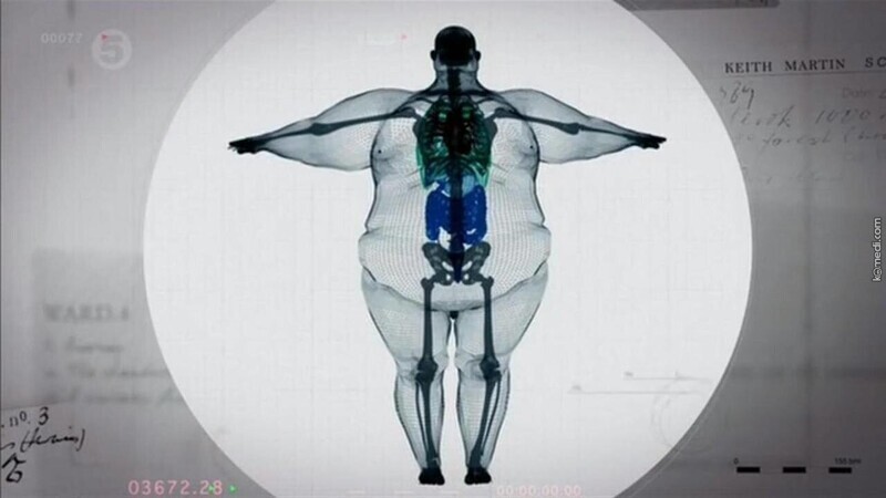 Скелет самого толстого человека в мире