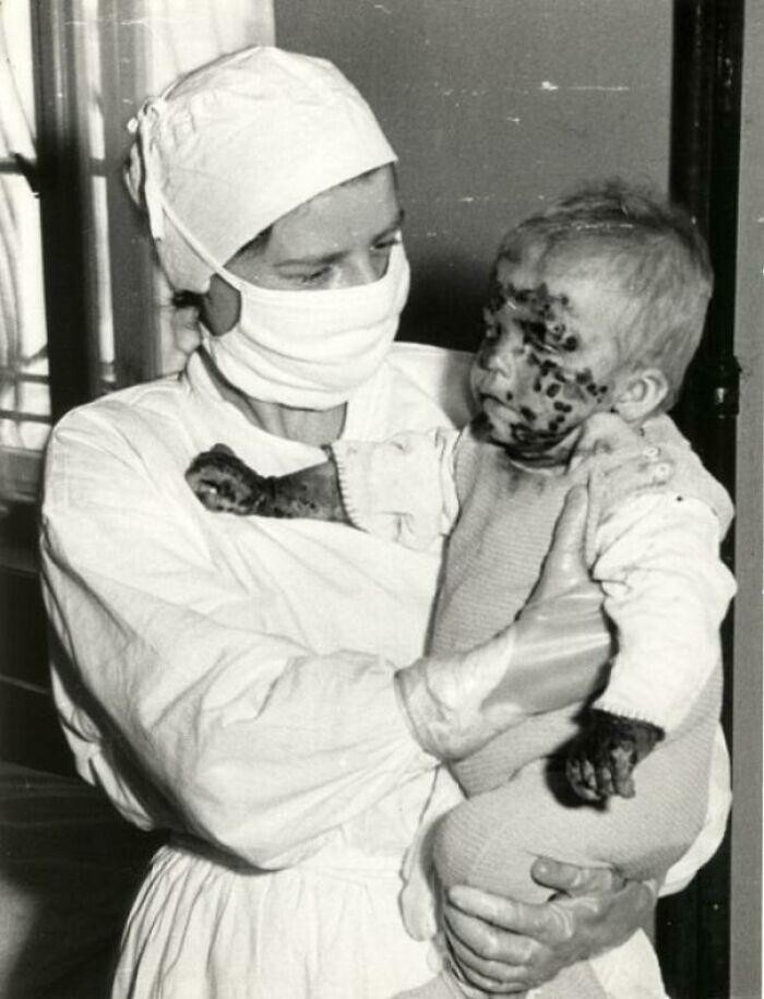 Медсестра с больным ребенком во время эпидемии оспы. Вроцлав, Польша, 1963 год