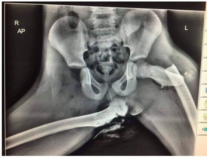8. Этот рентгеновский снимок участника аварии демонстрирует, почему нельзя класть ноги на приборную панель