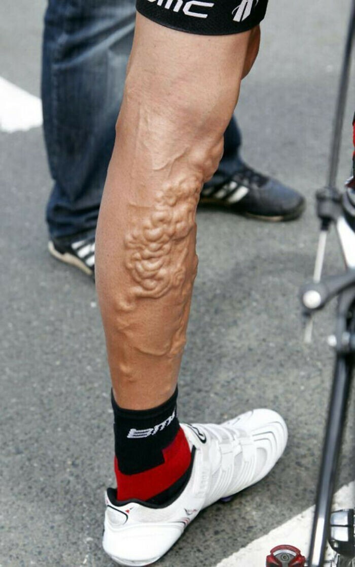 Нога велосипедиста Джорджа Хинкапи после "Тур де Франс"