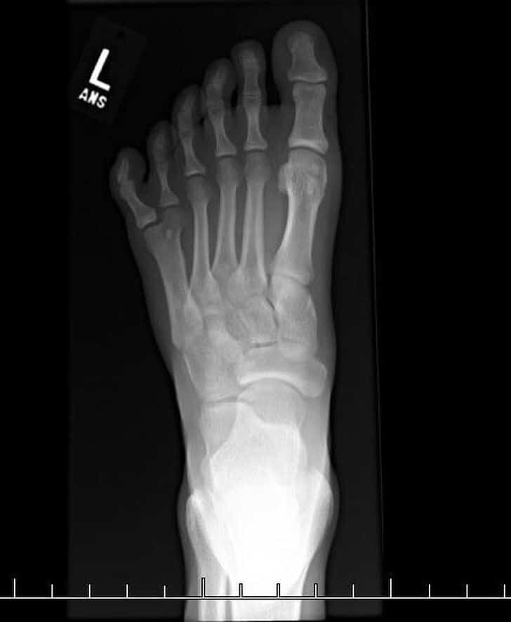 Рентгеновский снимок, у этого человека 6 пальцев на ногах