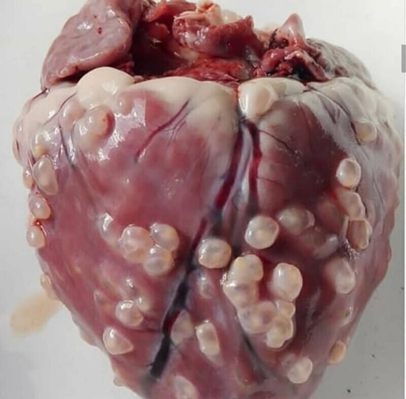 Цистицеркоз сердца у человека
