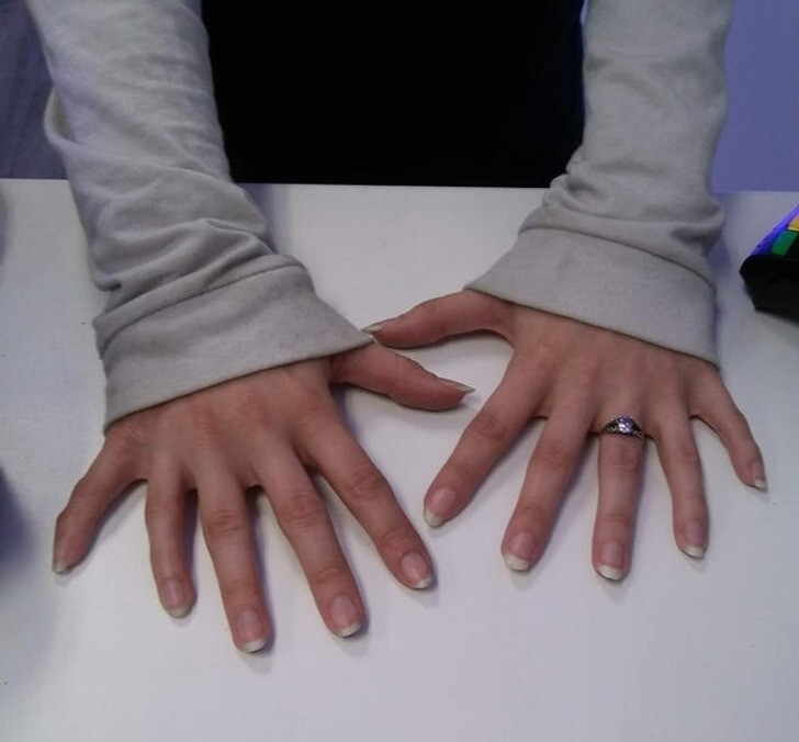 8. "Клиентка разрешила мне сфотографировать ее руки, на каждой из которых 6 пальцев"