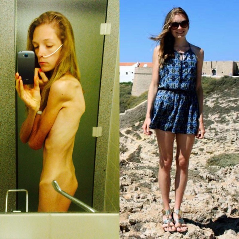 22-летняя Ханна показывает, на что была похожа, когда весила 31 килограмм!