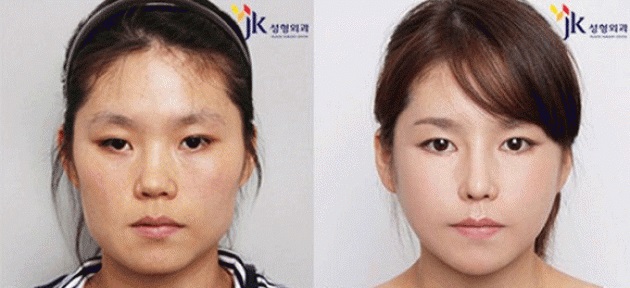 Чудеса случаются! Пластическая хирургия Южной Кореи, поражающая воображение