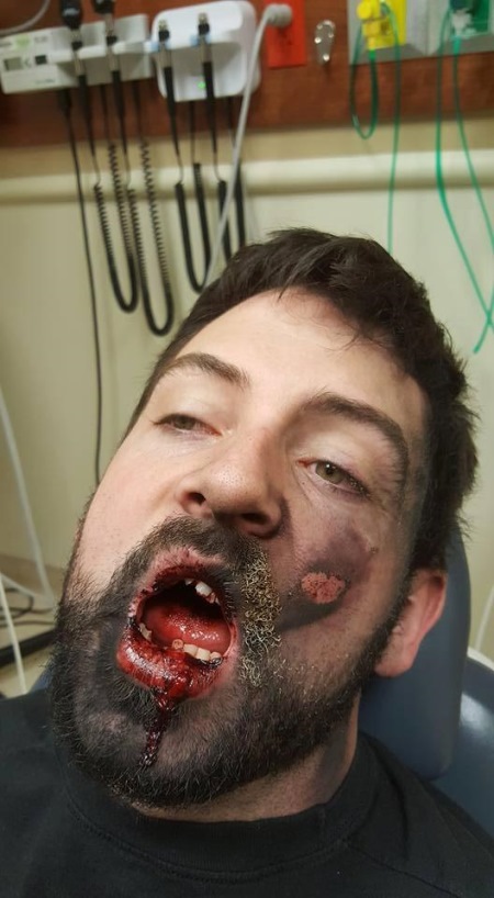 Взорвавшаяся электронная сигарета лишила 30-летнего мужчину нескольких зубов и наградила ожогами 2-й степени