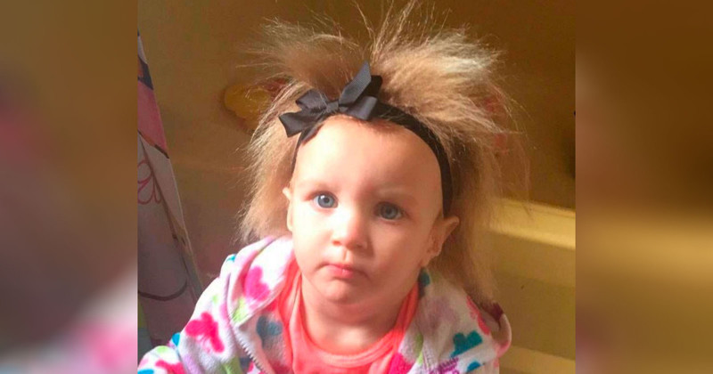 Малышке нельзя расчёсывать волосы из-за редкого заболевания, но ей это нравится