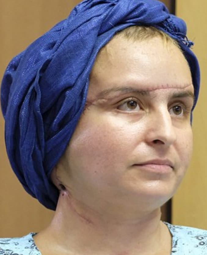 Три года спустя после трансплантации лица эта женщина выглядит потрясающе