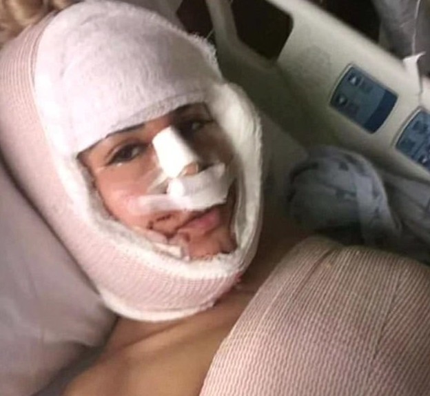 Женщина сделала 13 операций за год, чтобы стать похожей на Иванку Трамп