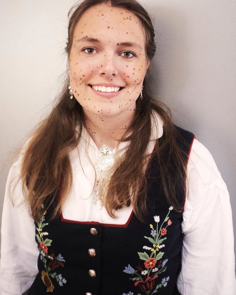22-летняя художница из Норвегии гордится миллионом своих родинок