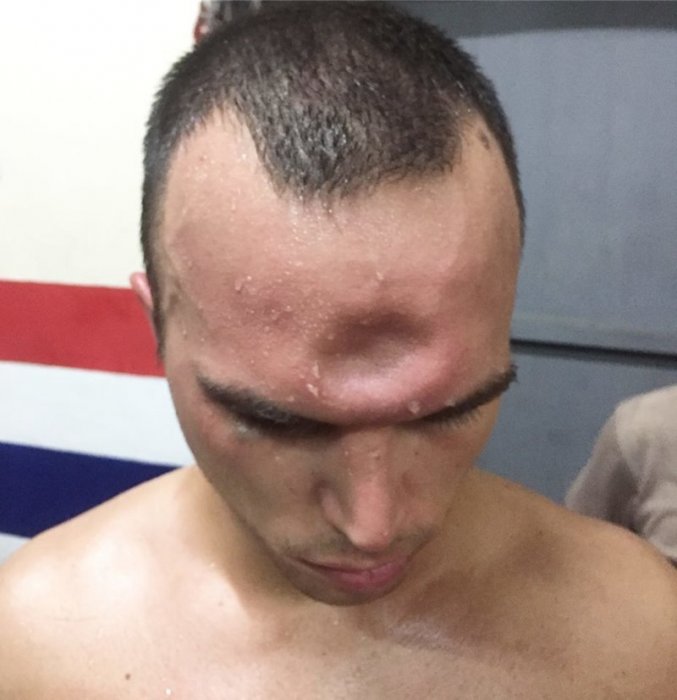 Французский боксер получил необычную травму