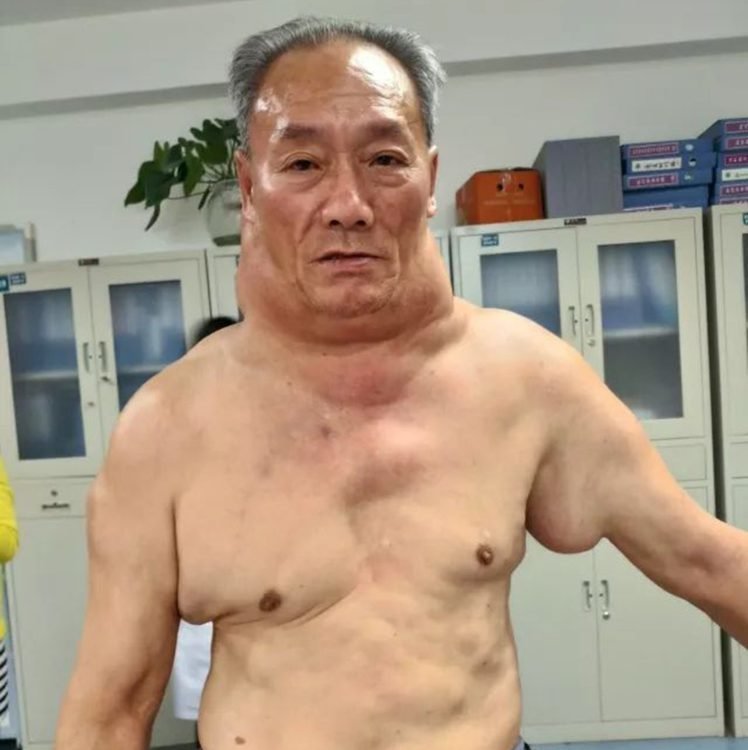 После 30 лет пьянства китаец превратился в «Халка»